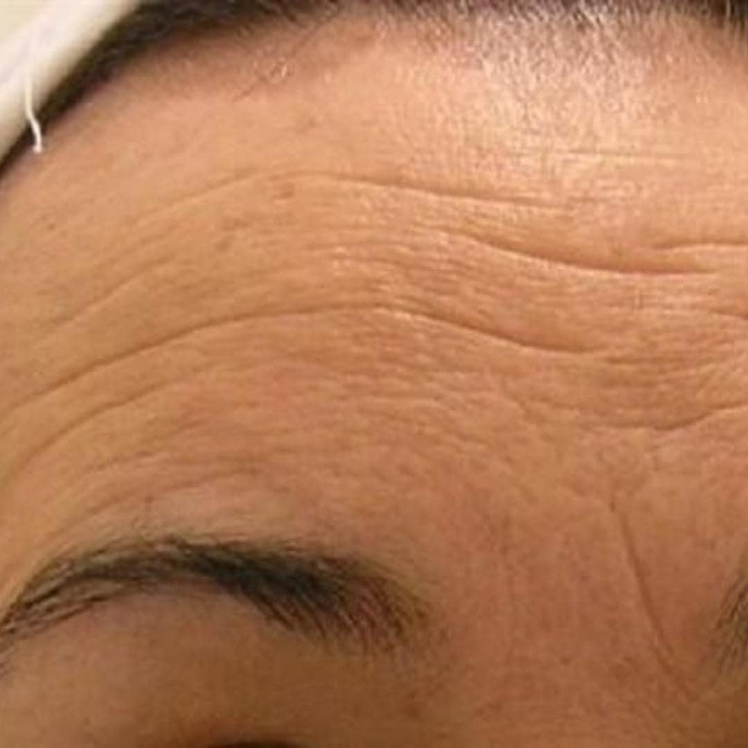 Arrugas frente dolor-articular-